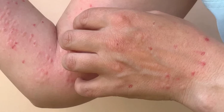 Understanding the Monkeypox Virus: How to Prevent the Spread